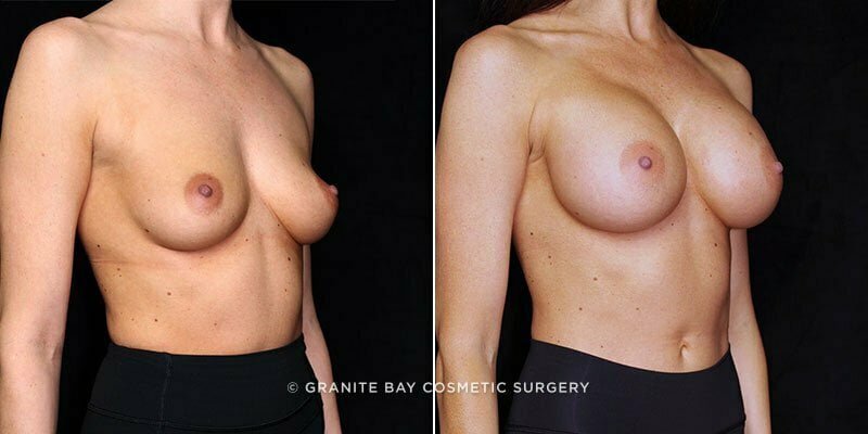 breast-augmentation-19830b-gbc
