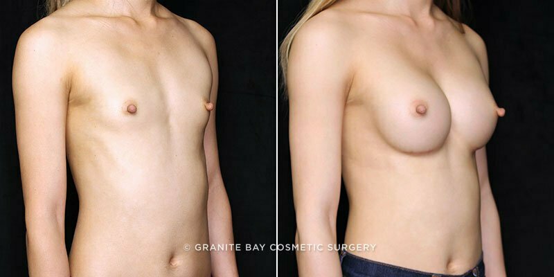 breast-augmentation-19983b-gbc
