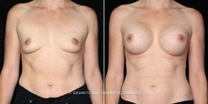 breast-augmentation-20621a-gbc