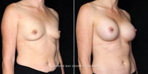 breast-augmentation-20621b-gbc