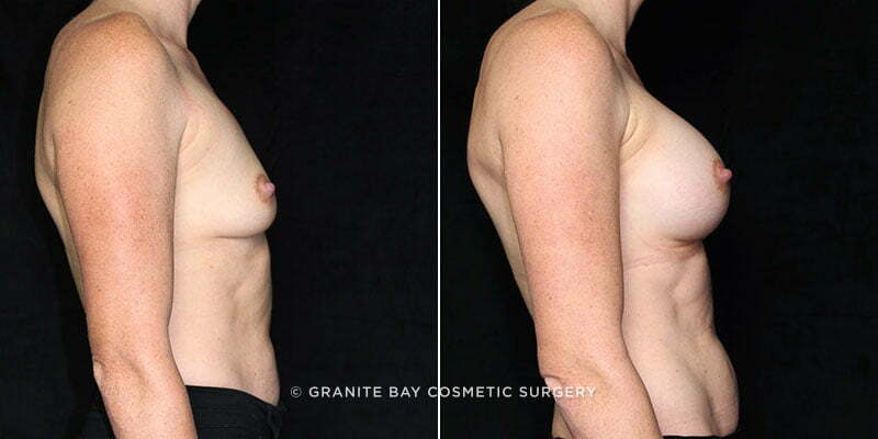 breast-augmentation-20621c-gbc