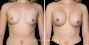 breast-augmentation-20862a-gbc