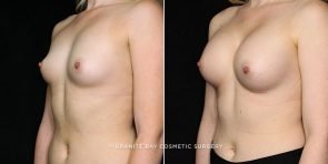 breast-augmentation-20862b-gbc