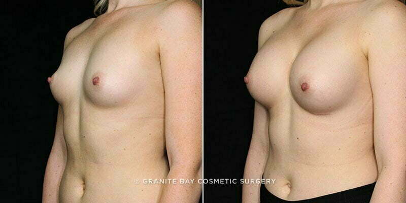 breast-augmentation-20862b-gbc