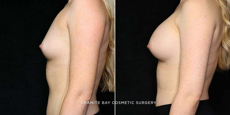 breast-augmentation-20862c-gbc