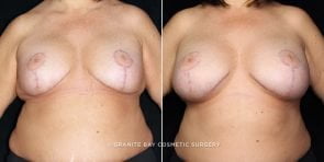 breast-implant-exchange-18594a-gbc