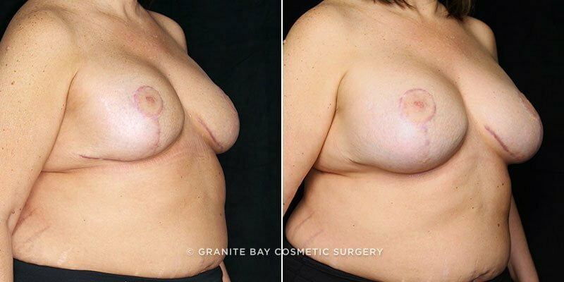 breast-implant-exchange-18594b-gbc