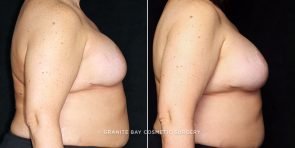 breast-implant-exchange-18594c-gbc