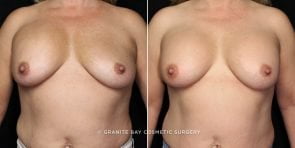 breast-implant-exchange-20855a-gbc