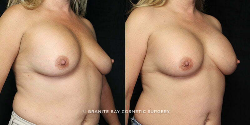 breast-implant-exchange-20855b-gbc