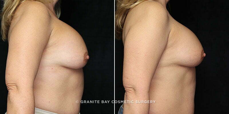 breast-implant-exchange-20855c-gbc