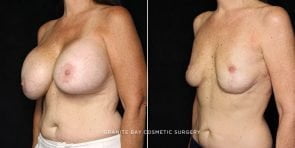 breast-implant-exchange-lift-20463b-gbc