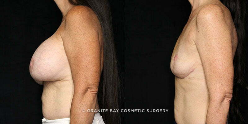 breast-implant-exchange-lift-20463c-gbc