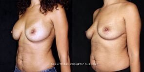 breast-implant-removal-20054b-gbc