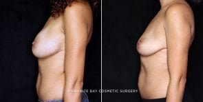 breast-implant-removal-20054c-gbc