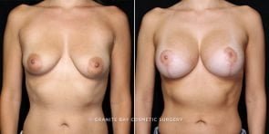 breast-lift-with-augmentation-20213a-gbc