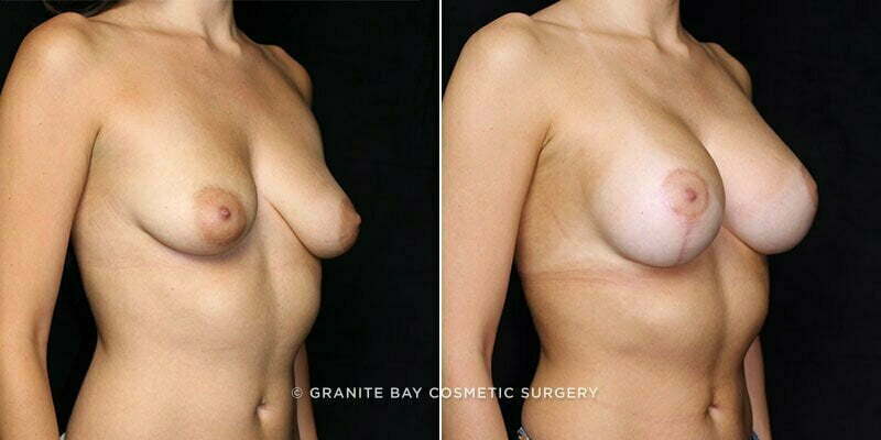 breast-lift-with-augmentation-20213b-gbc