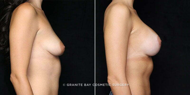 breast-lift-with-augmentation-20213c-gbc