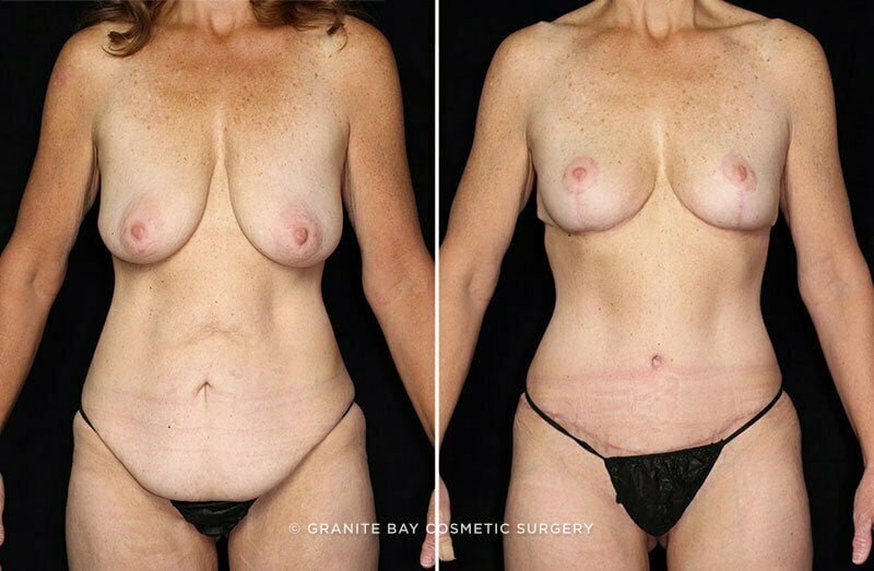 Breast Lift, Tummy Tuck, Body Lift, & Thigh Lift