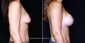 breast-augmentation-20765c-gbc