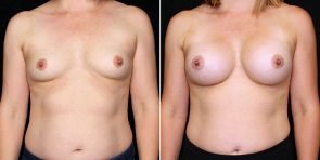 breast-augmentation-20816a-gbc