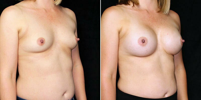 breast-augmentation-20816b-gbc
