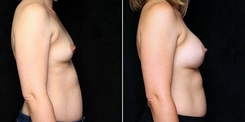 breast-augmentation-20816c-gbc