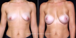 breast-augmentation-21250a-gbc