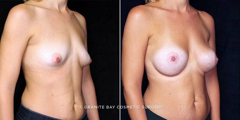 breast-augmentation-21250b-gbc