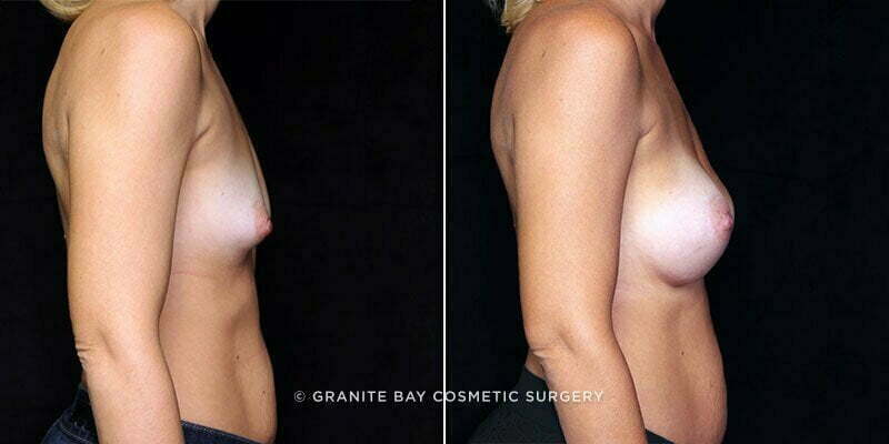 breast-augmentation-21250c-gbc