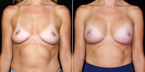 breast-augmentation-22230a-gbc
