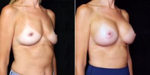 breast-augmentation-22230b-gbc