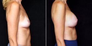 breast-augmentation-22230c-gbc