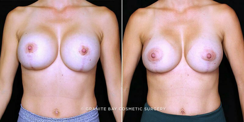 breast-implant-revision-13464a-gbc