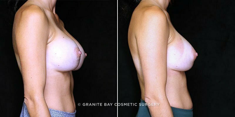 breast-implant-revision-downsize-13464c-gbc