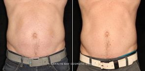coolsculpting-20517a-gbc-watermarked