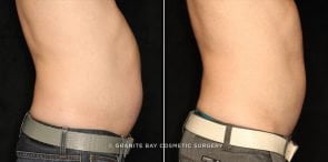 coolsculpting-20517c-gbc-watermarked