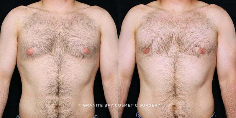 Male Breast Reduction