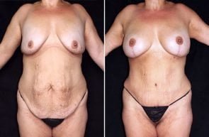mommy-makeover-br-lift-implants-tt-19715a-gbc