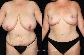 abdominoplasty-breast-reduction-18709a-gbc