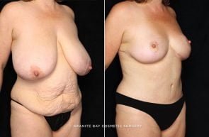 abdominoplasty-breast-reduction-18709b-gbc