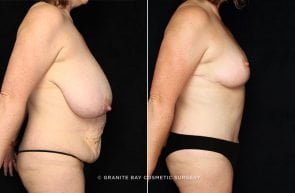 abdominoplasty-breast-reduction-18709c-gbc