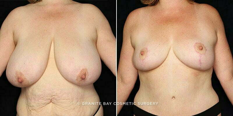 Breast Reduction