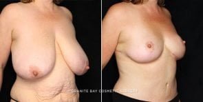 breast-reduction-18709b-gbc