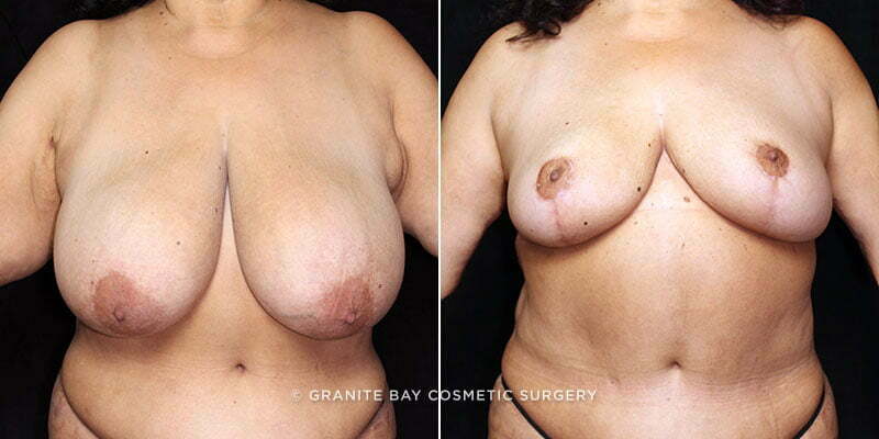 Breast Reduction