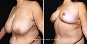 breast-reduction-20798b-gbc
