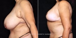 breast-reduction-20798c-gbc