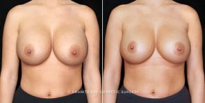 breast-revision-smaller-implants-14673a-gbc