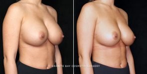 breast-revision-smaller-implants-14673b-gbc