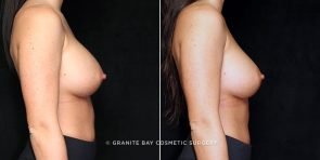 breast-revision-smaller-implants-14673c-gbc